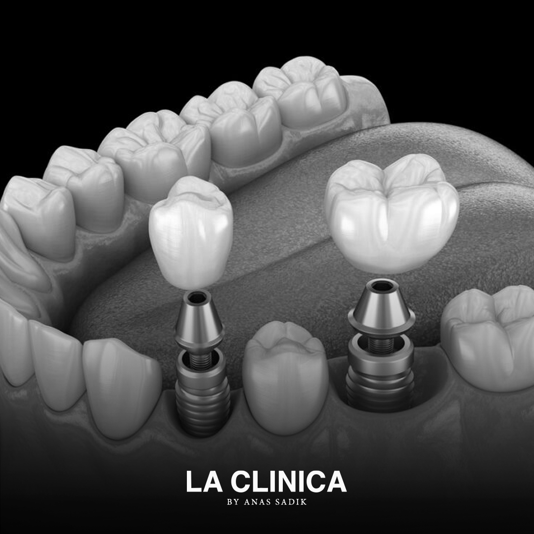 أفضل تركيبات أسنان ثابتة في الرياض