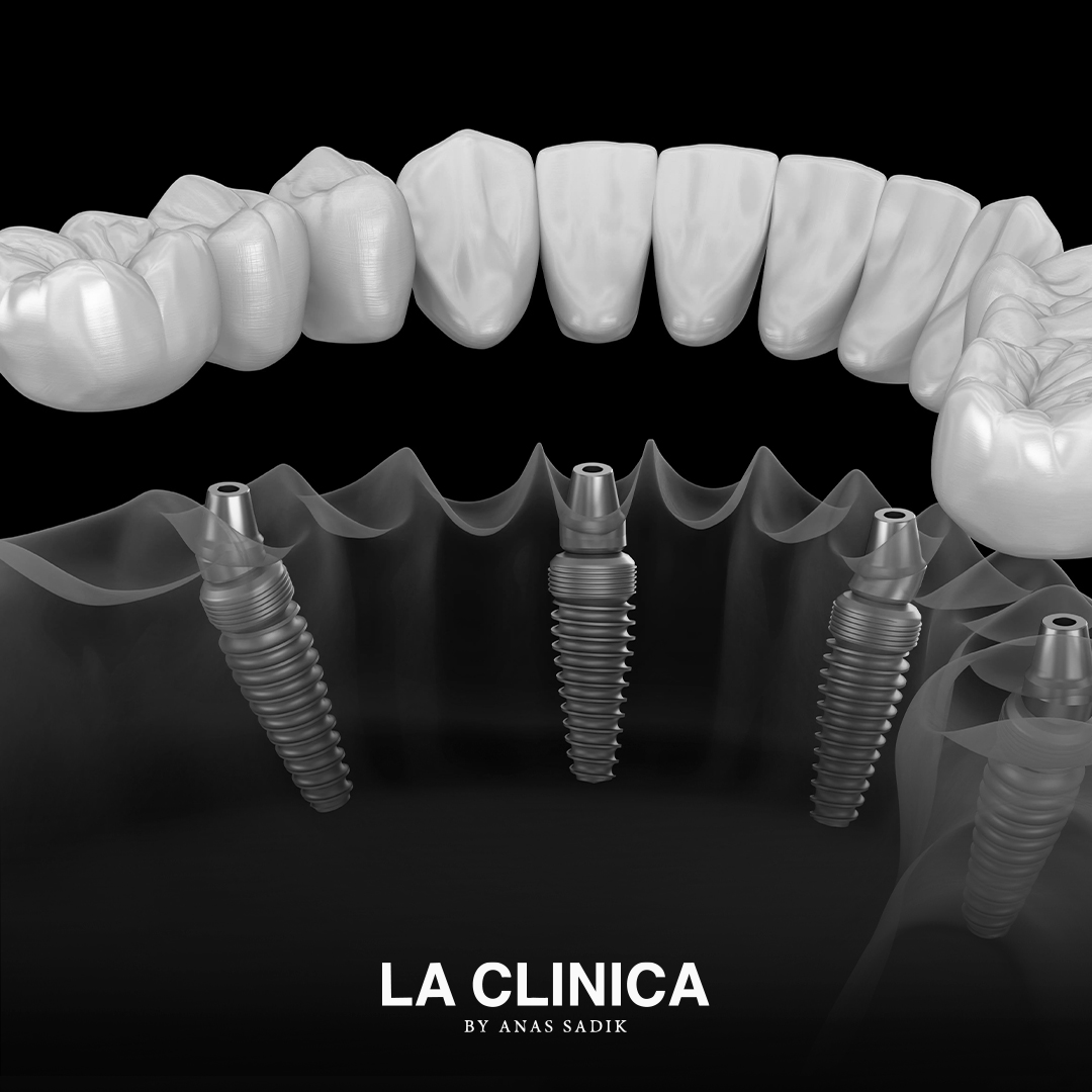 الفرق بين التركيبات الثابتة والمتحركة للأسنان