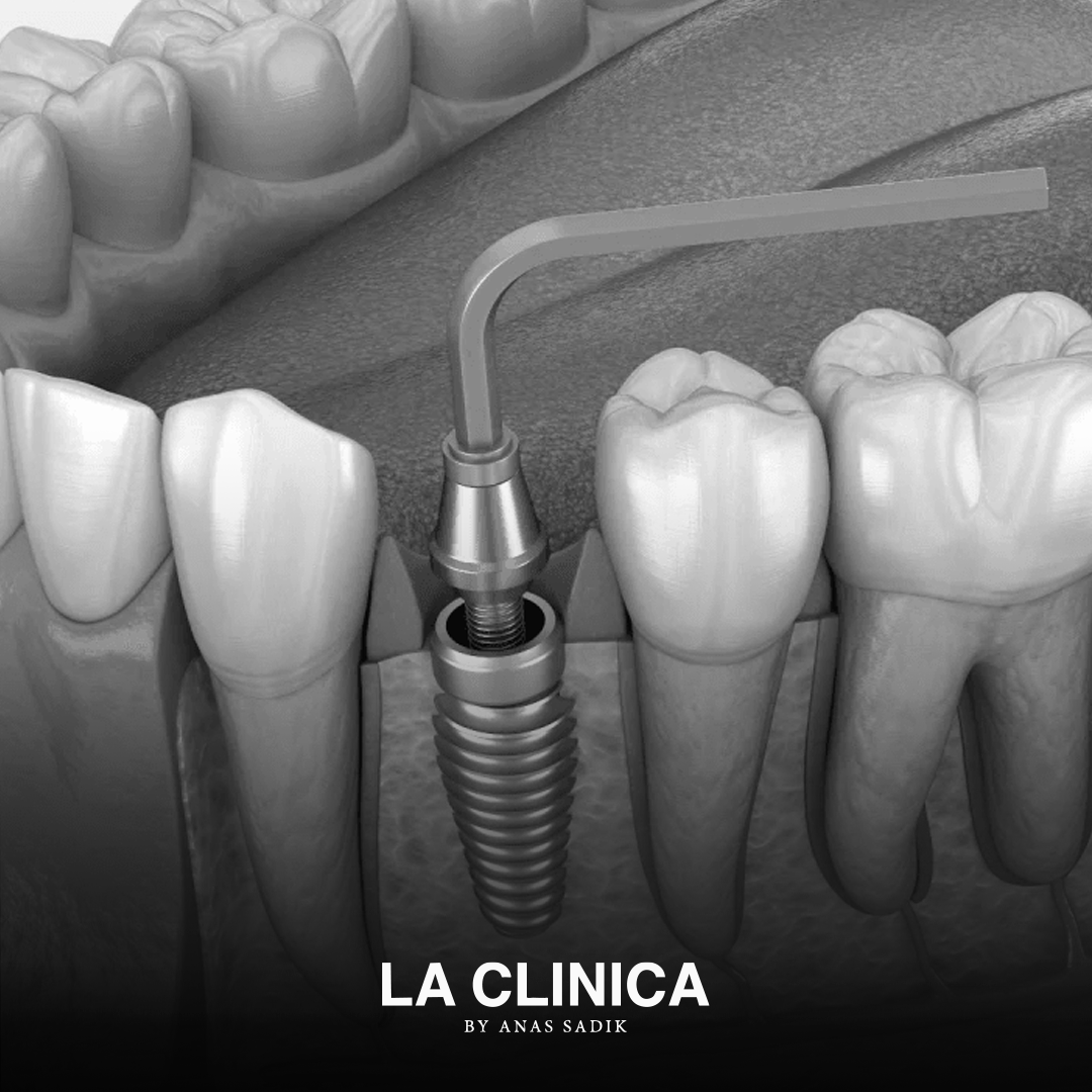 الفرق بين زراعة الأسنان التقليدية والفورية