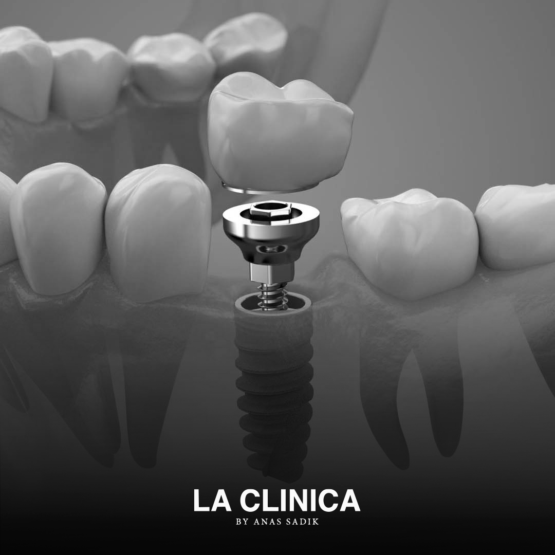 زراعة سن واحد أمامي بالرياض