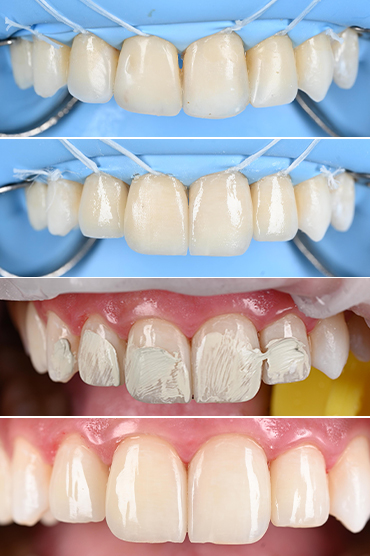 حشوات تجميلية