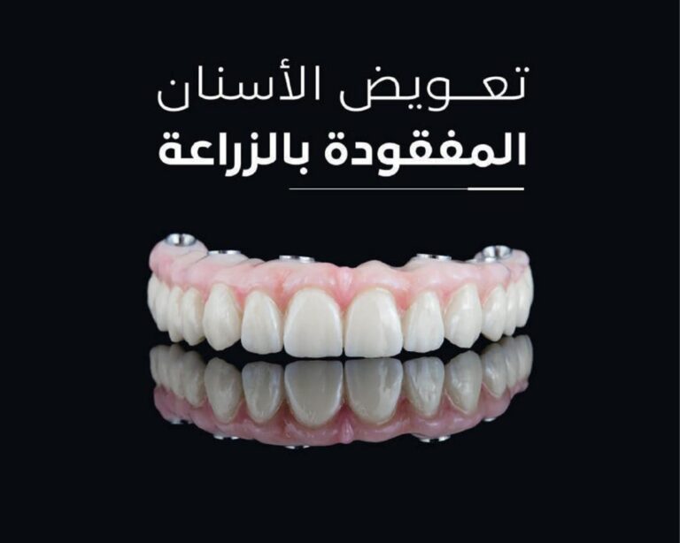 Dental Implants