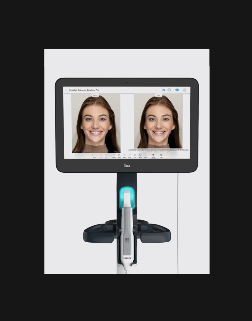 The iTero intraoral scanner
