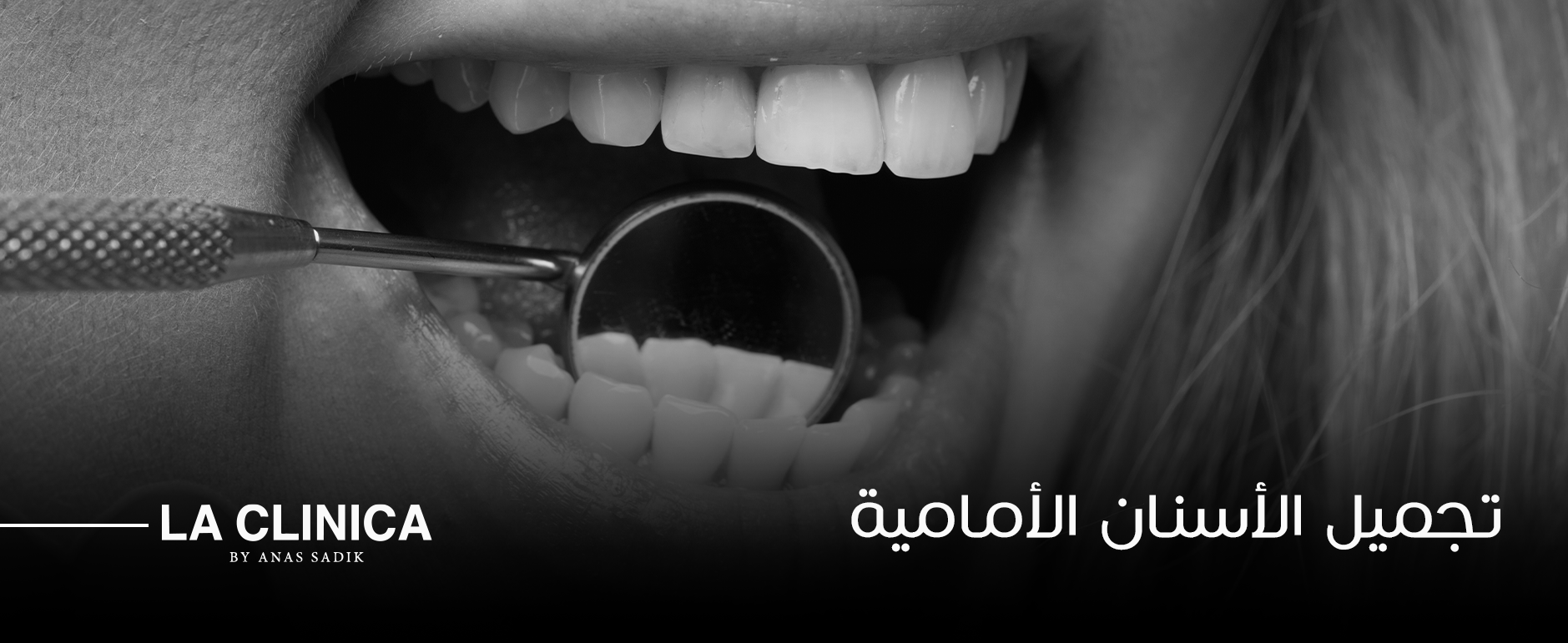 تجميل الأسنان الأمامية في La Clinica ثقة أكثر وابتسامة أجمل