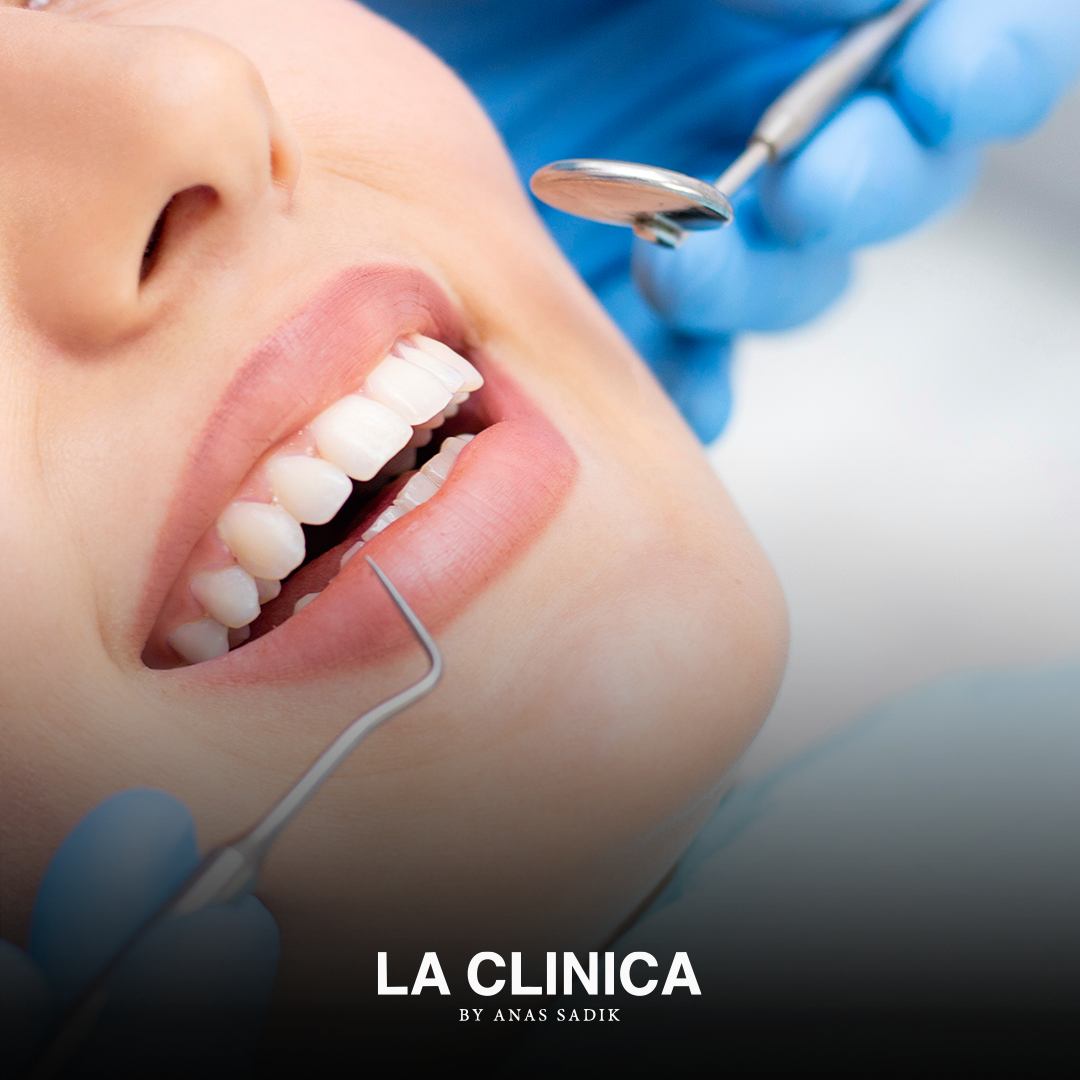 تجميل الأسنان الأمامية بدون تقويم