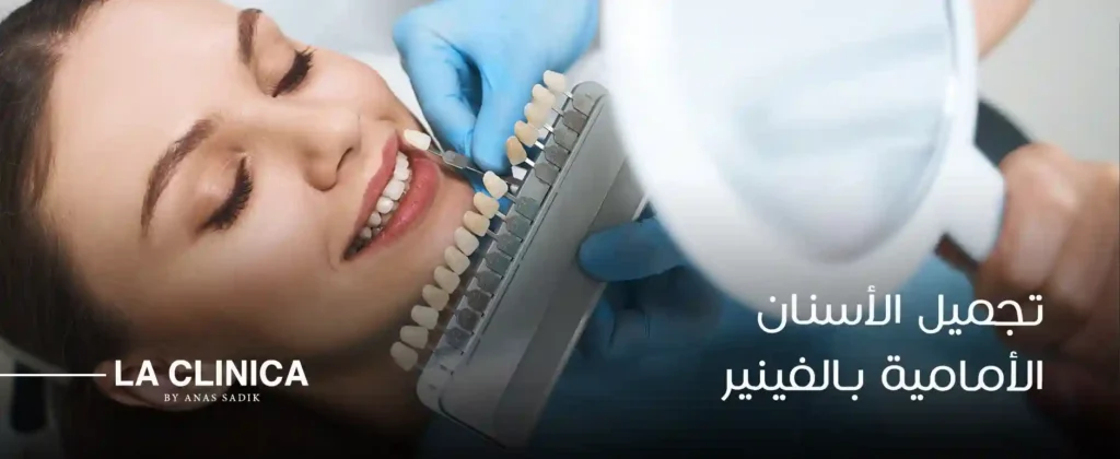 تجميل الأسنان الأمامية بالفينير