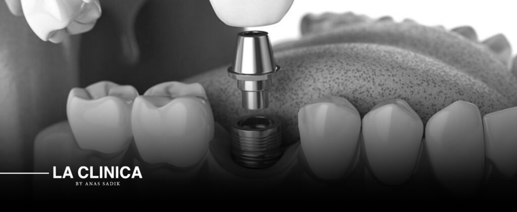 أفضل تركيبات أسنان ثابتة في الرياض