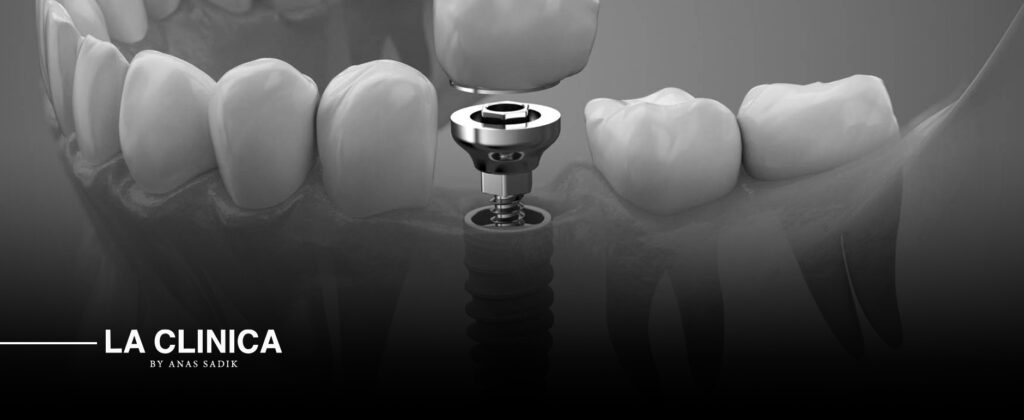 الفرق بين التركيبات الثابتة والمتحركة للأسنان