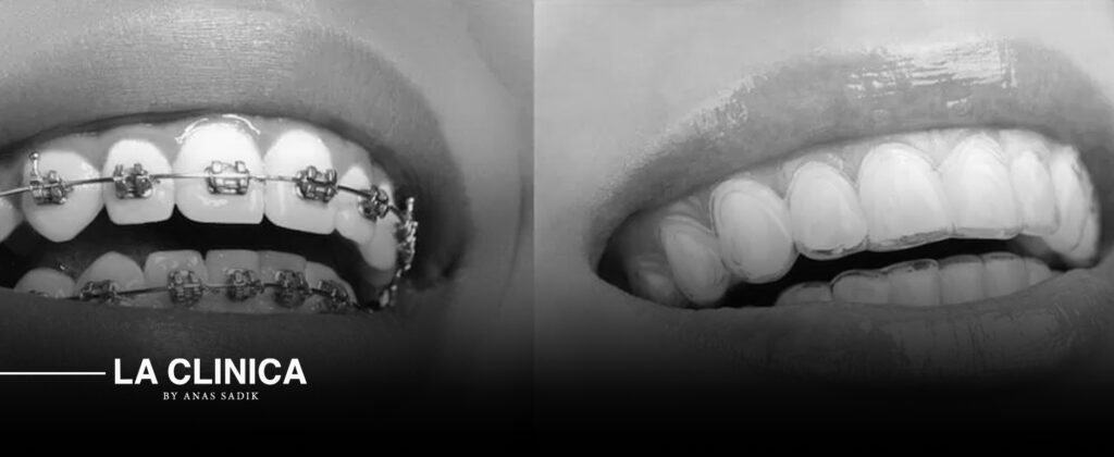 الفرق بين تقويم الأسنان الشفاف إنفزلاين والتقويم التقليدي