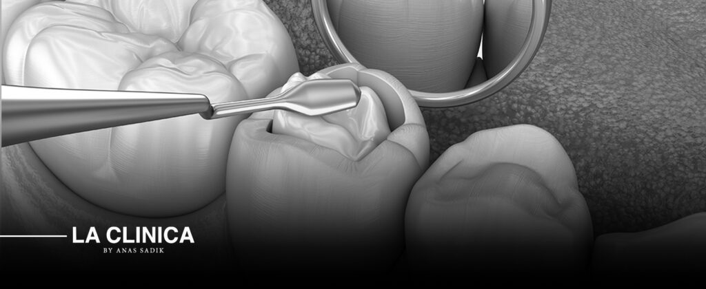 حشوات أسنان كومبوزيت في الرياض