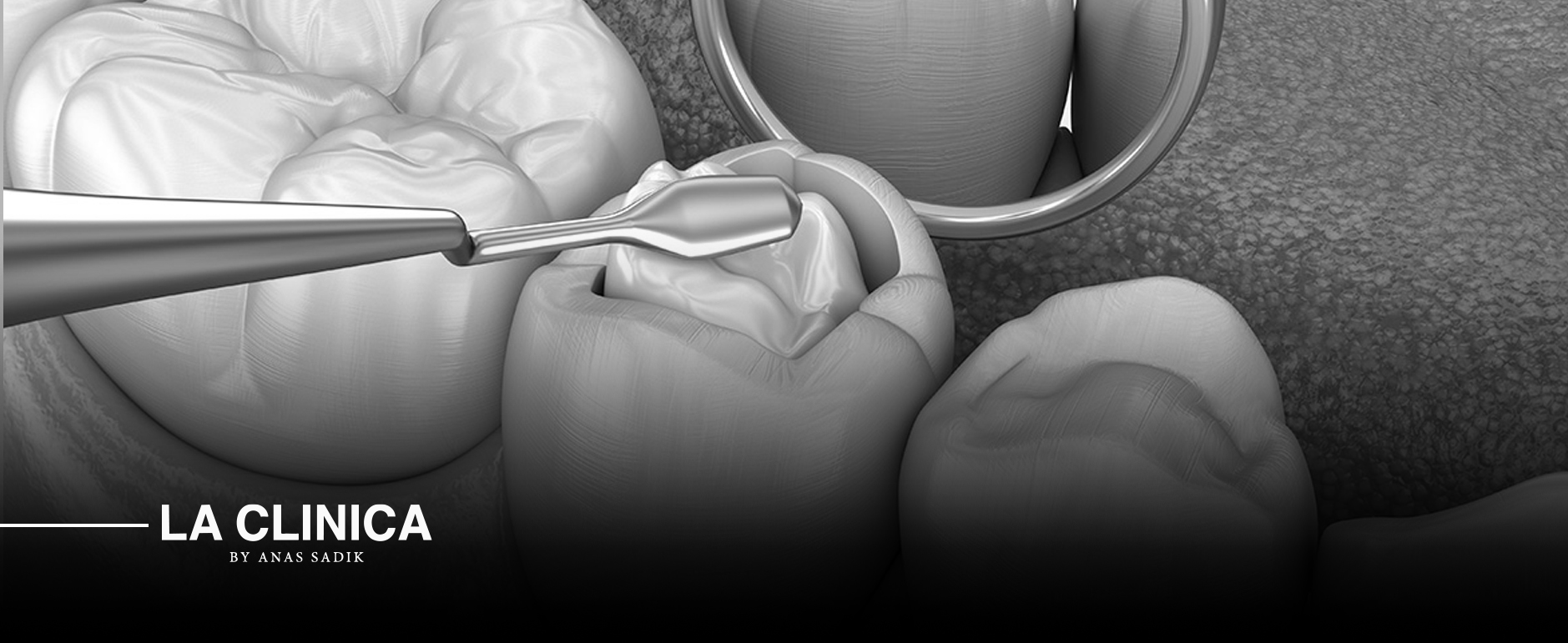 حشوات أسنان كومبوزيت في الرياض: دليلك للابتسامة التجميلية المثالية