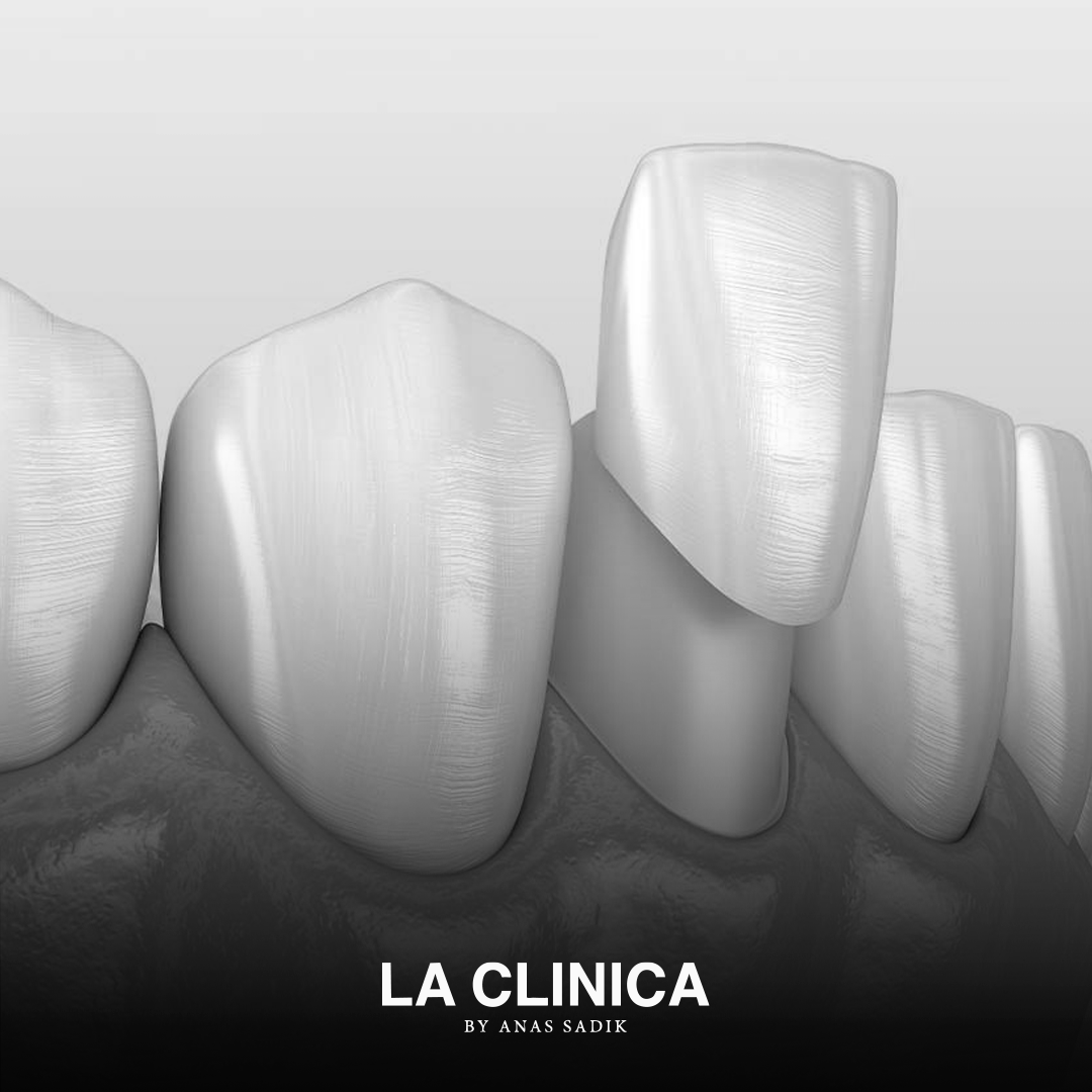 تركيبة أسنان تجميلية لتعويض الأسنان المفقودة