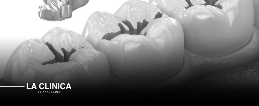 حشو تجميلي لإصلاح الأسنان المتشققة