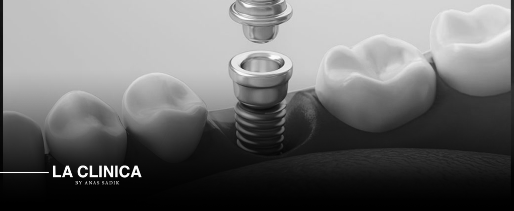 زراعة سن واحد أمامي بالرياض