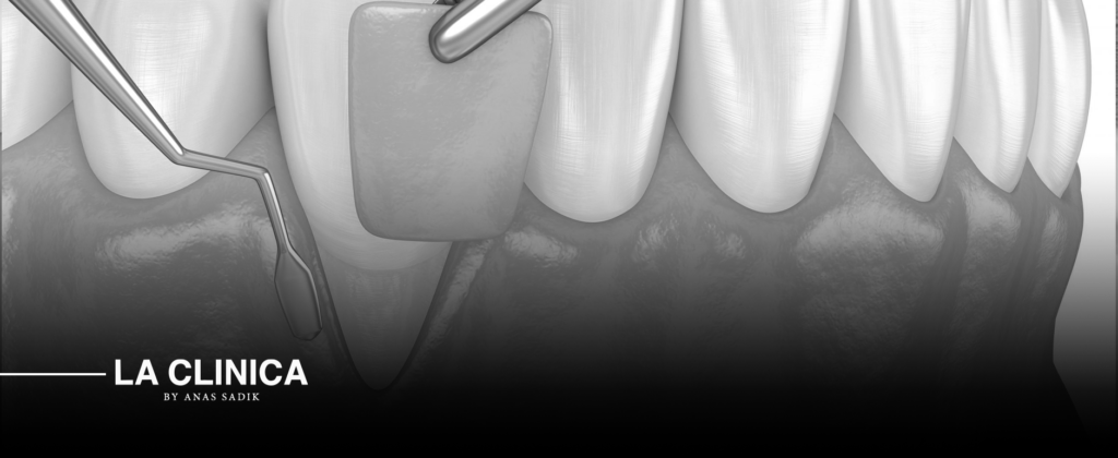 علاج انحسار اللثة