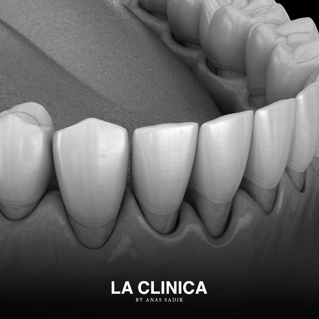 علاج انحسار اللثة