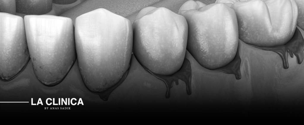 علاج نزيف اللثة