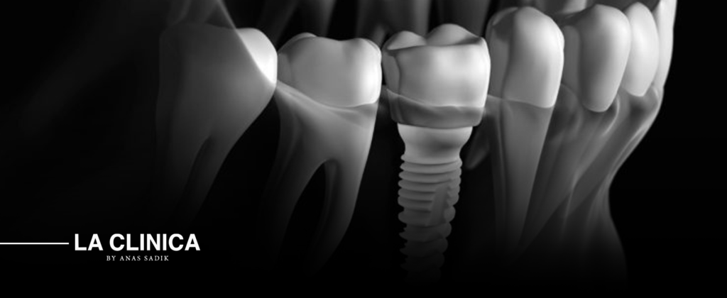 كم تكلفة تركيبات الأسنان الزيركون في الرياض