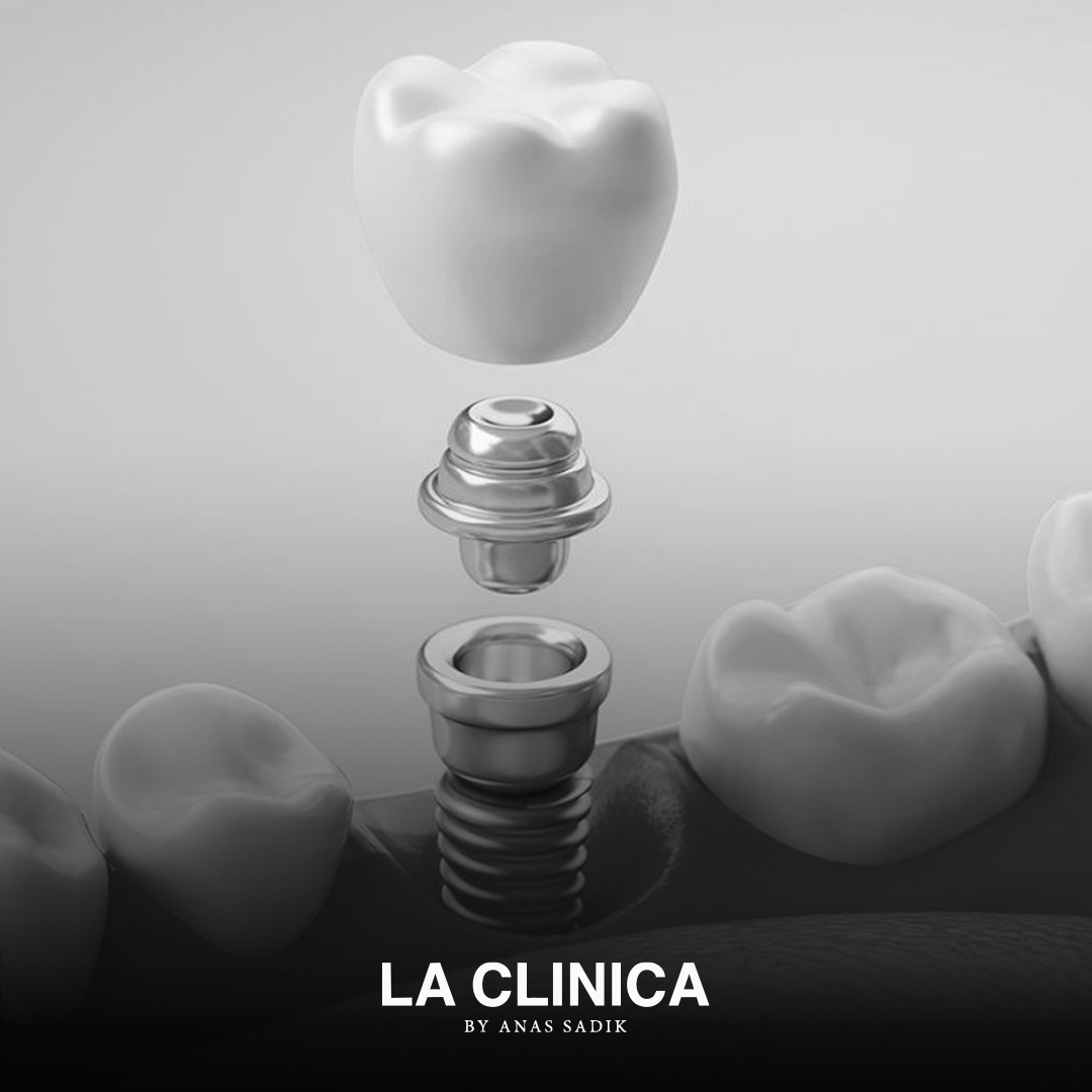 نسبة نجاح زراعة الأسنان في السعودية