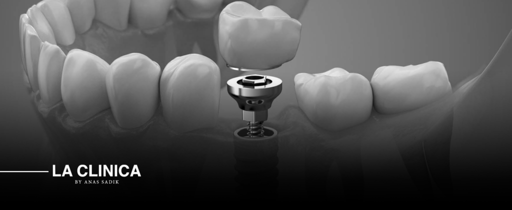 نسبة نجاح زراعة الأسنان في السعودية