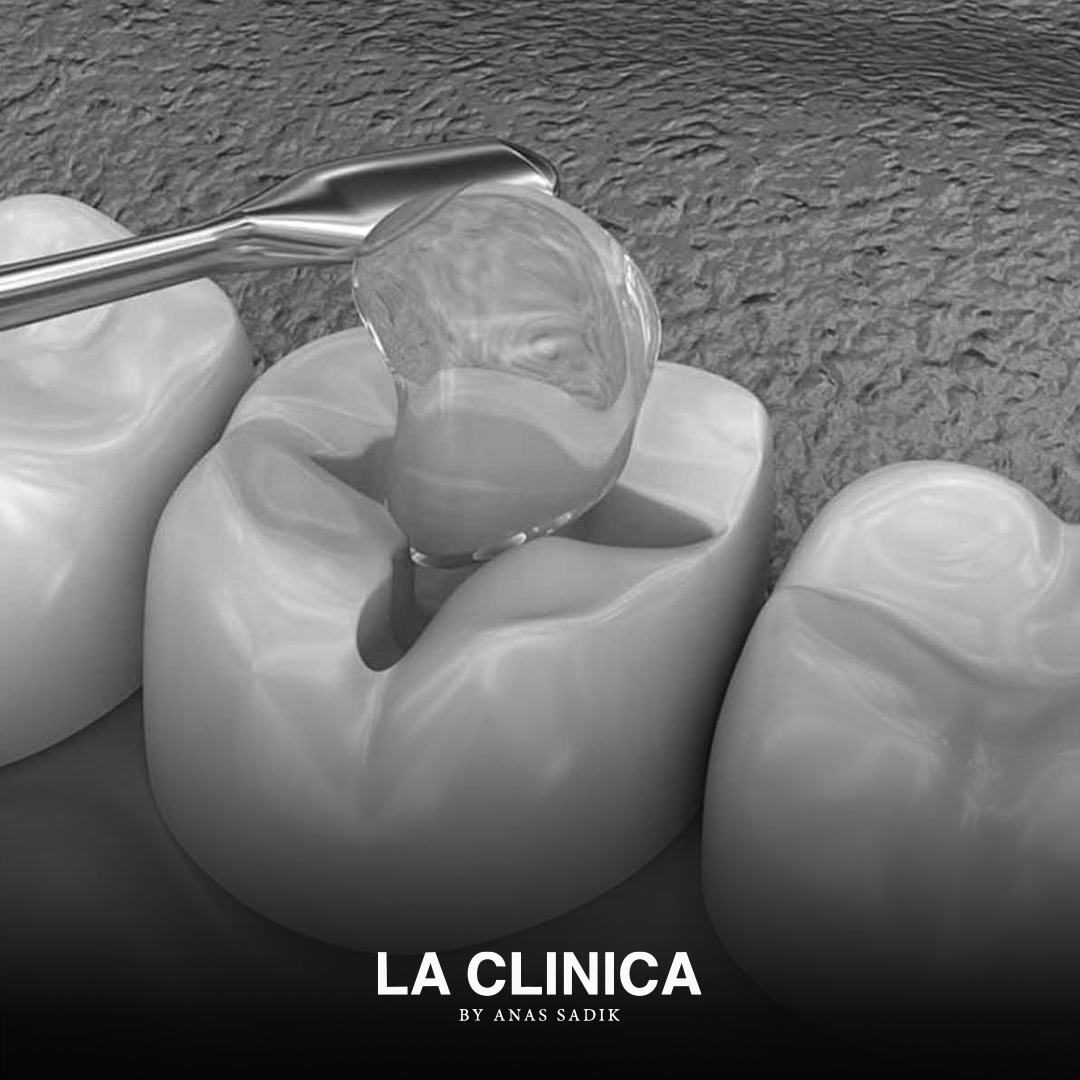 Dental Fillings in Riyadh