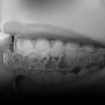 Get Expert Invisalign in Riyadh Treatment by Certified Specialists