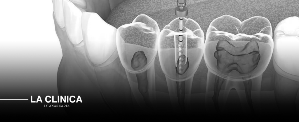 Root Canal Treatment Riyadh