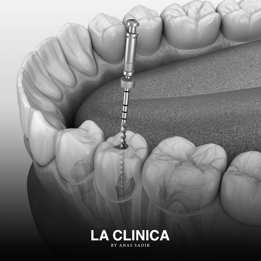 Root Canal Treatment Riyadh