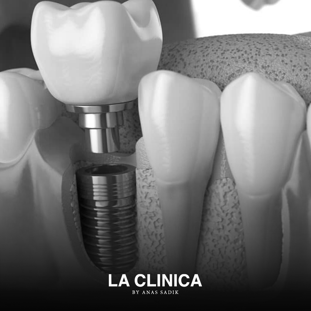 أفضل دكتور تركيبات زيركون في الرياض