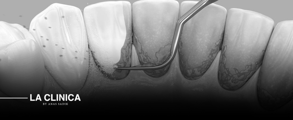 إزالة الجير من الأسنان
