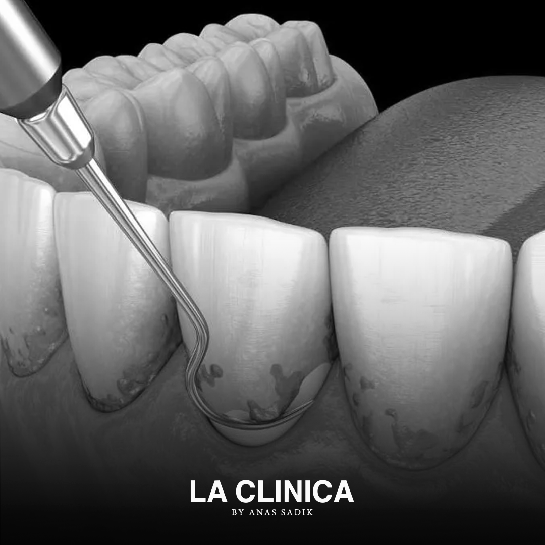 إزالة الجير من الأسنان