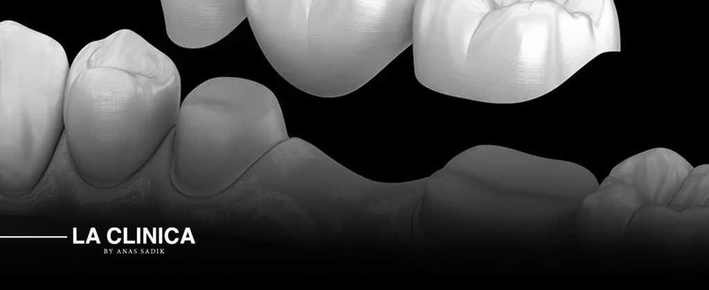 إعادة بناء الأسنان