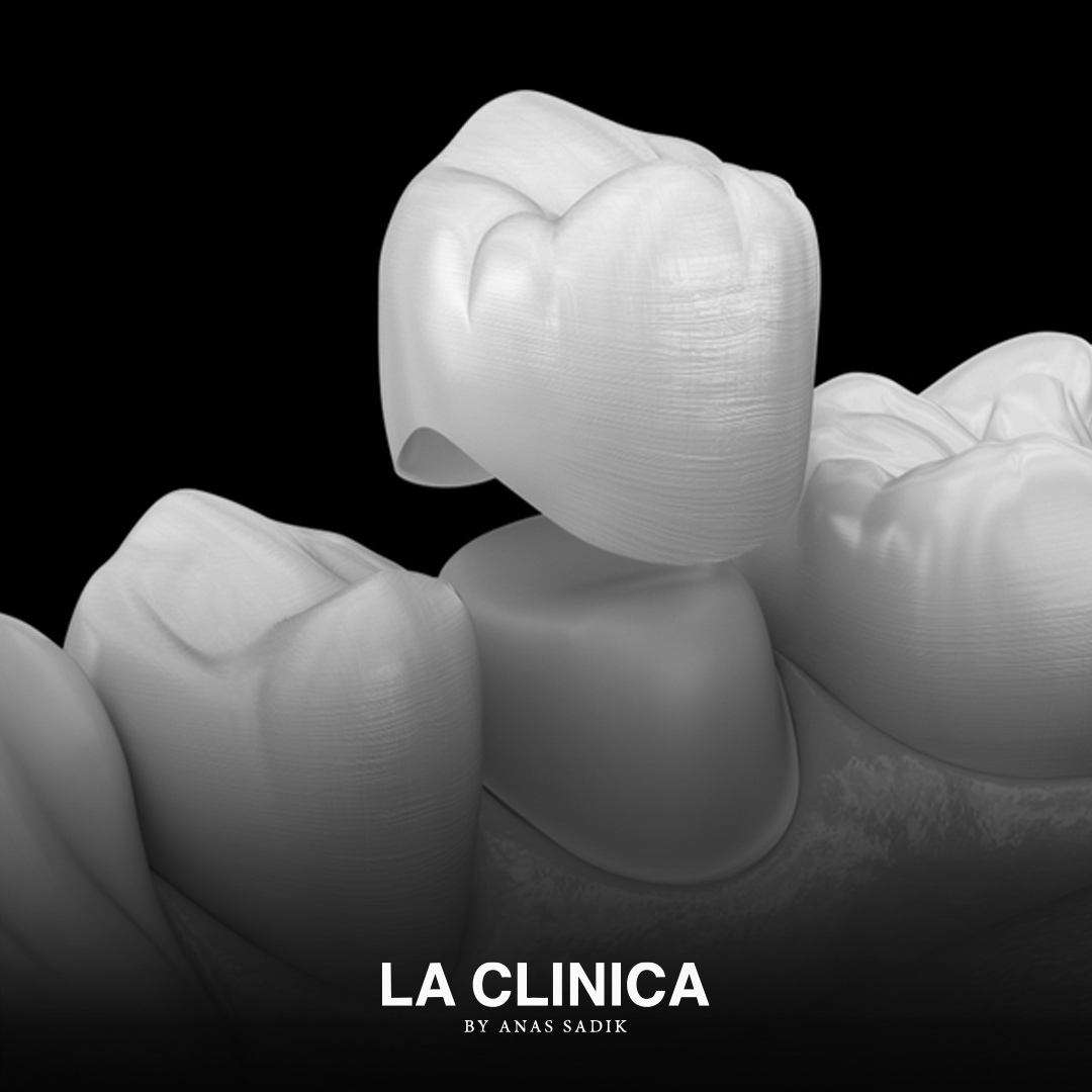 إعادة بناء الأسنان