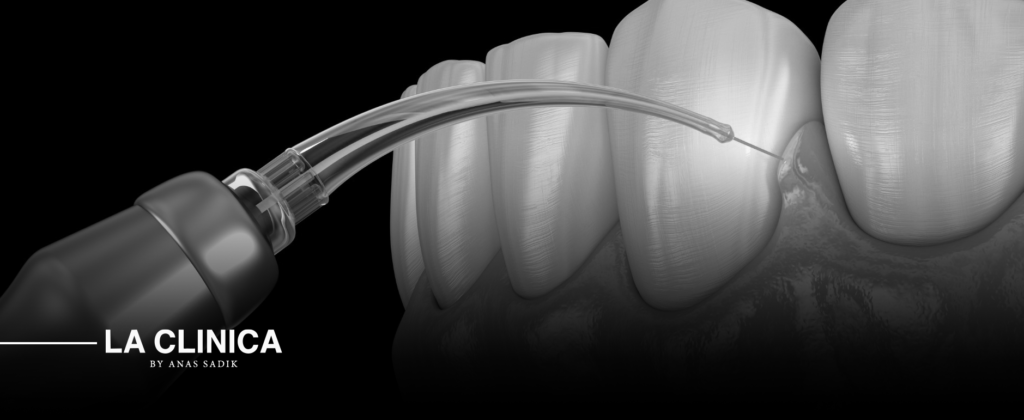 تجميل اللثة بالليزر