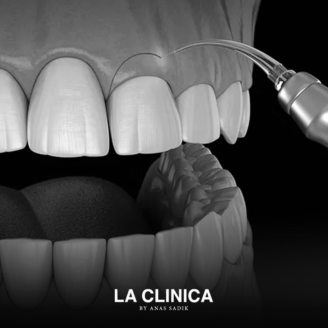 تجميل اللثة بالليزر