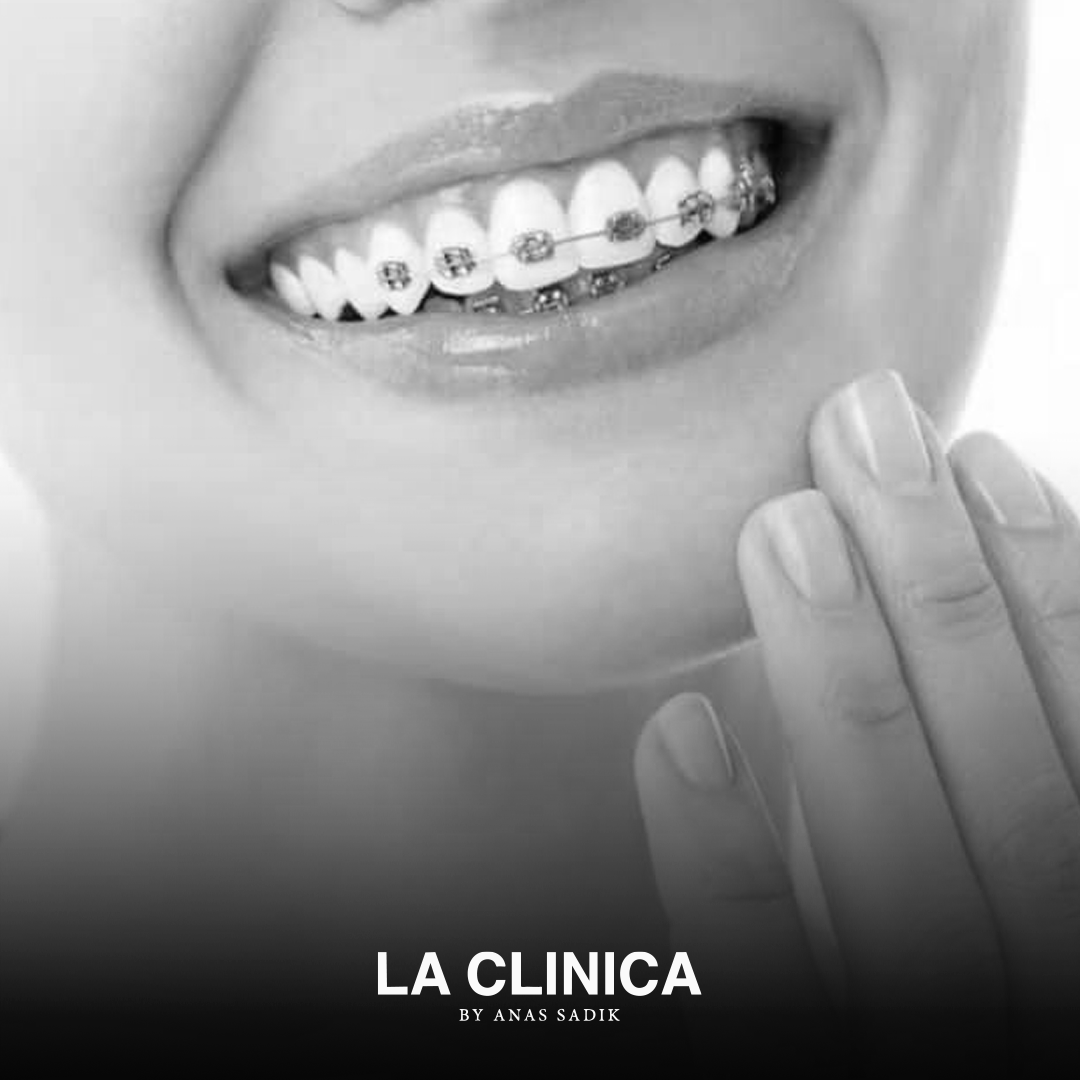 تلميع الأسنان بعد التقويم