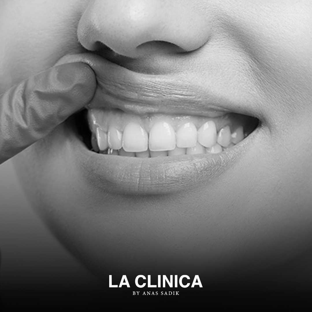 جراحة اللثة التجميلية