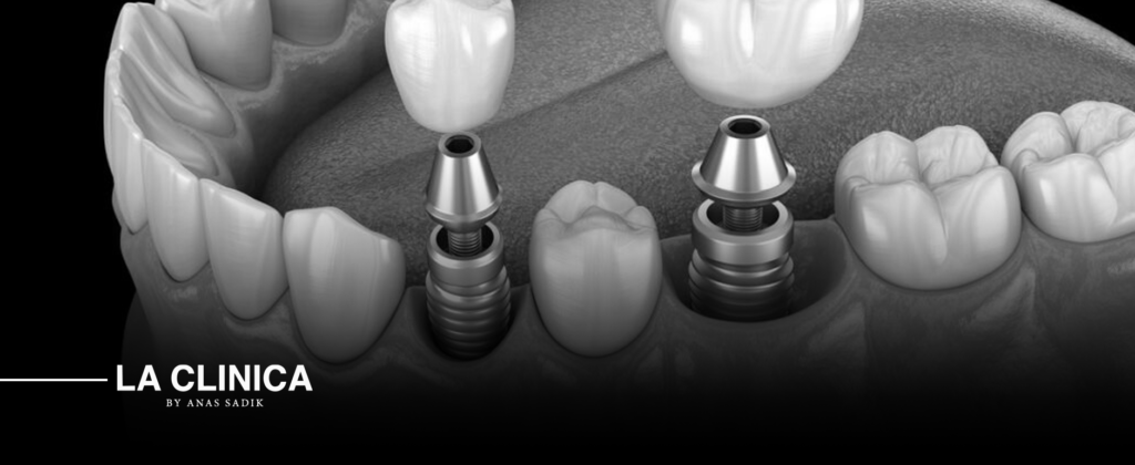 زراعة الأسنان الفورية