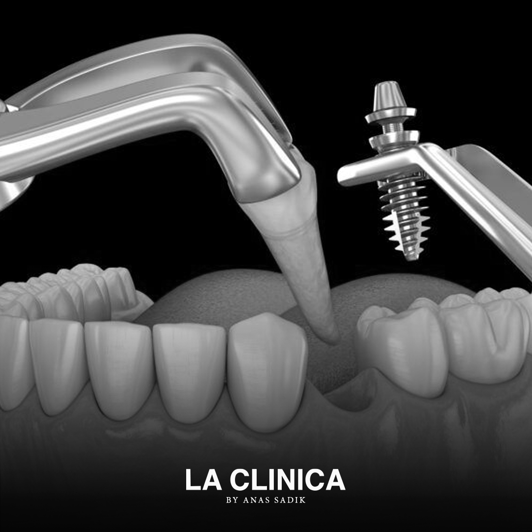 زراعة الأسنان الفورية