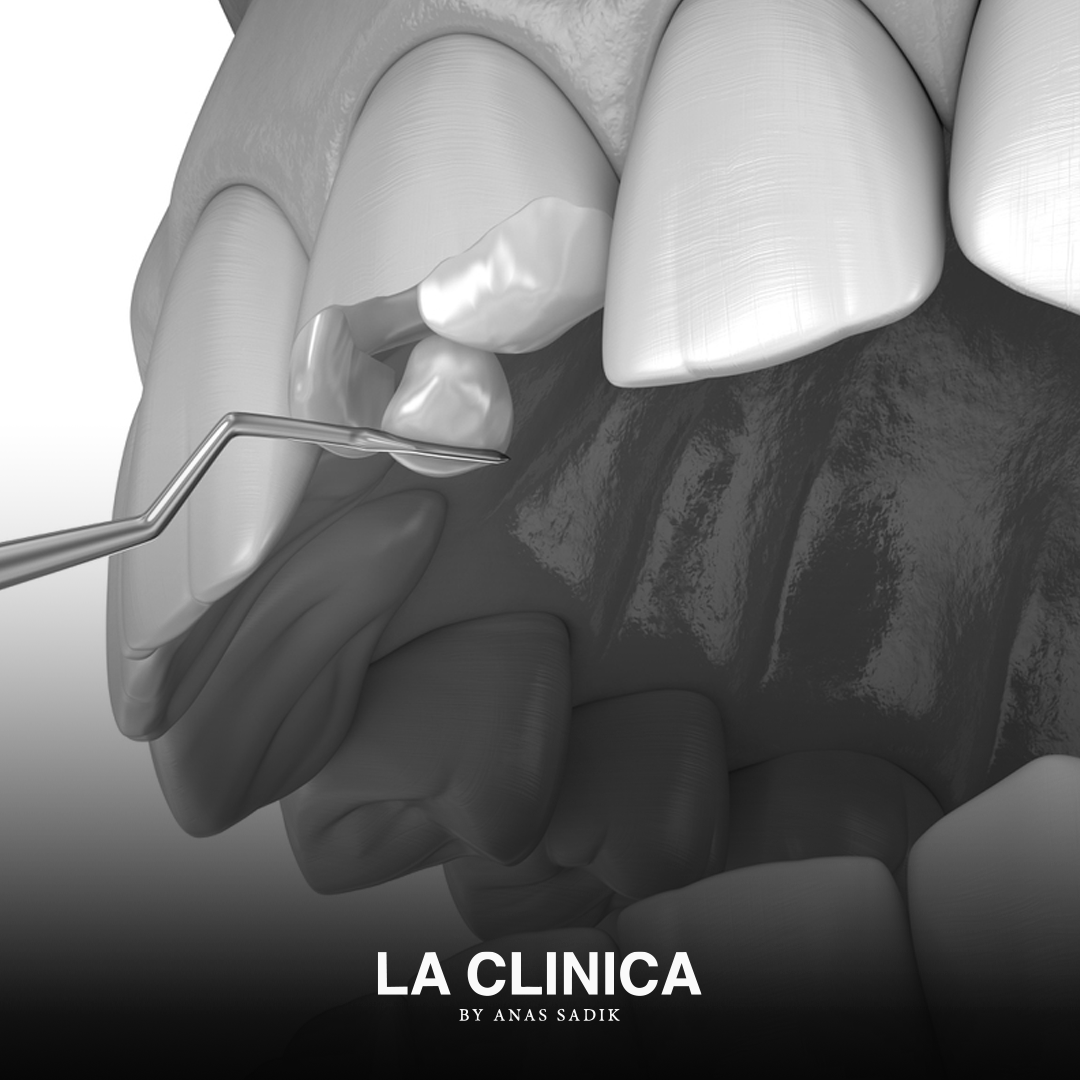 علاج الأسنان المكسورة