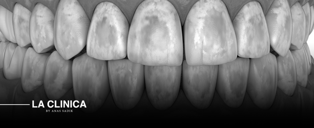 علاج تصبغات الأسنان