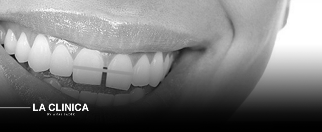 علاج فراغات الأسنان