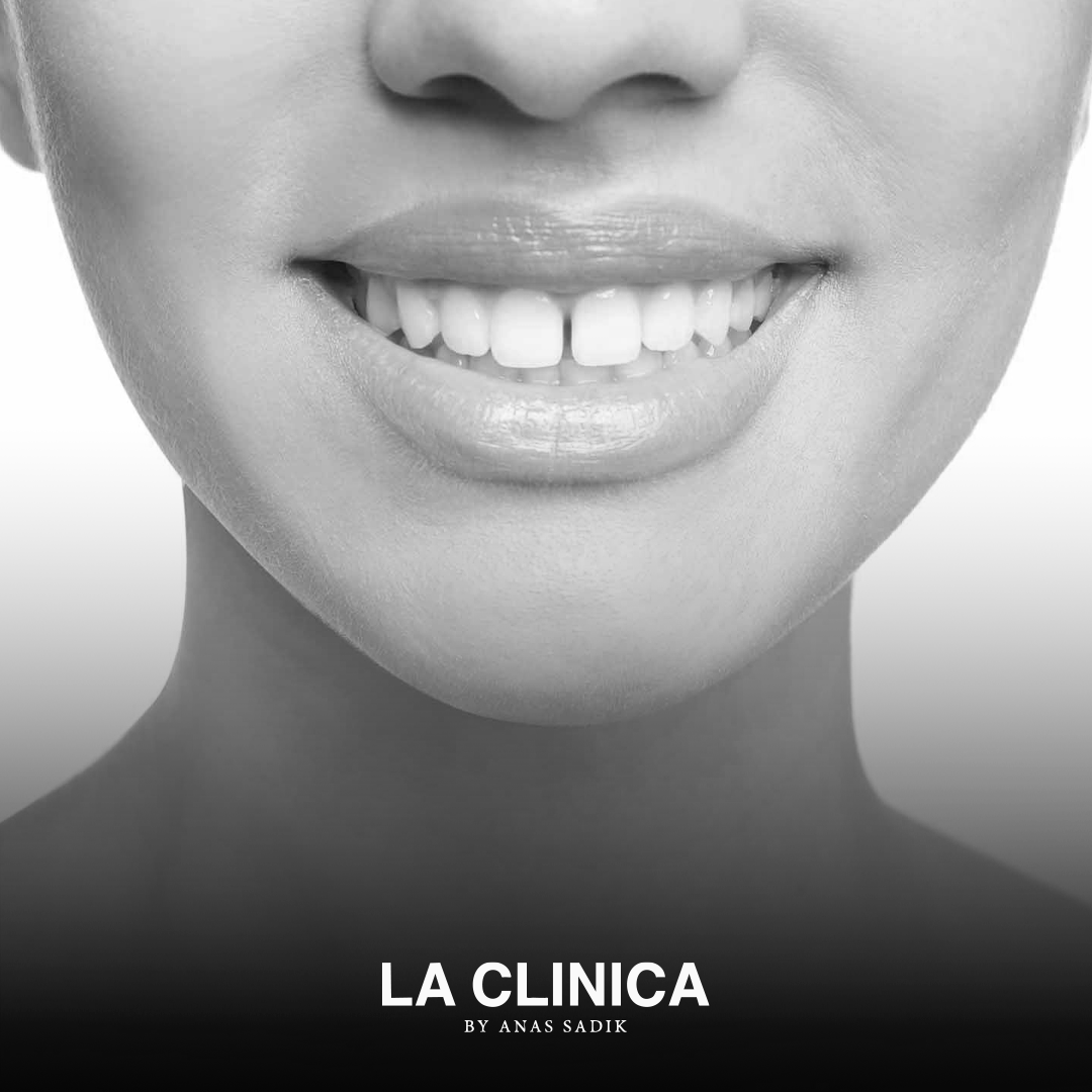 علاج فراغات الأسنان