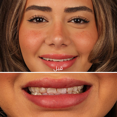 الاستشارة المبدئية
