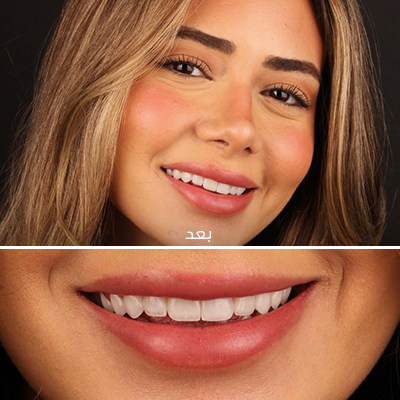 تركيب الابتسامة الدائمة
