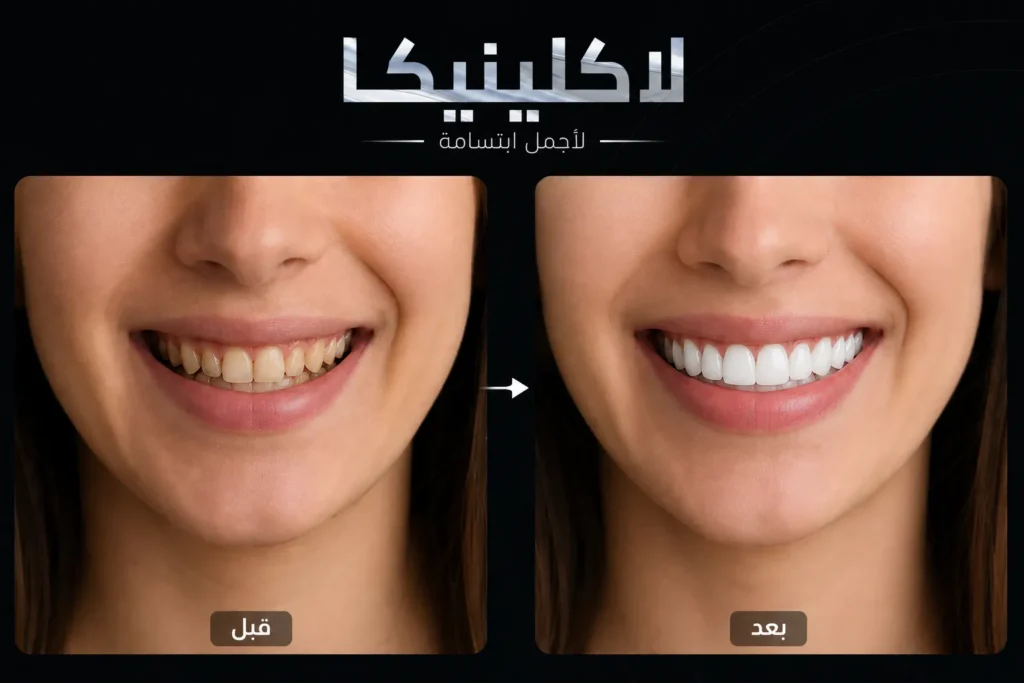 تجربتي مع تركيبات الزيركون