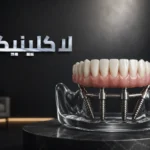 زراعة الأسنان all on 4 في الرياض: دليلك الشامل لاستعادة ابتسامتك في يوم واحد