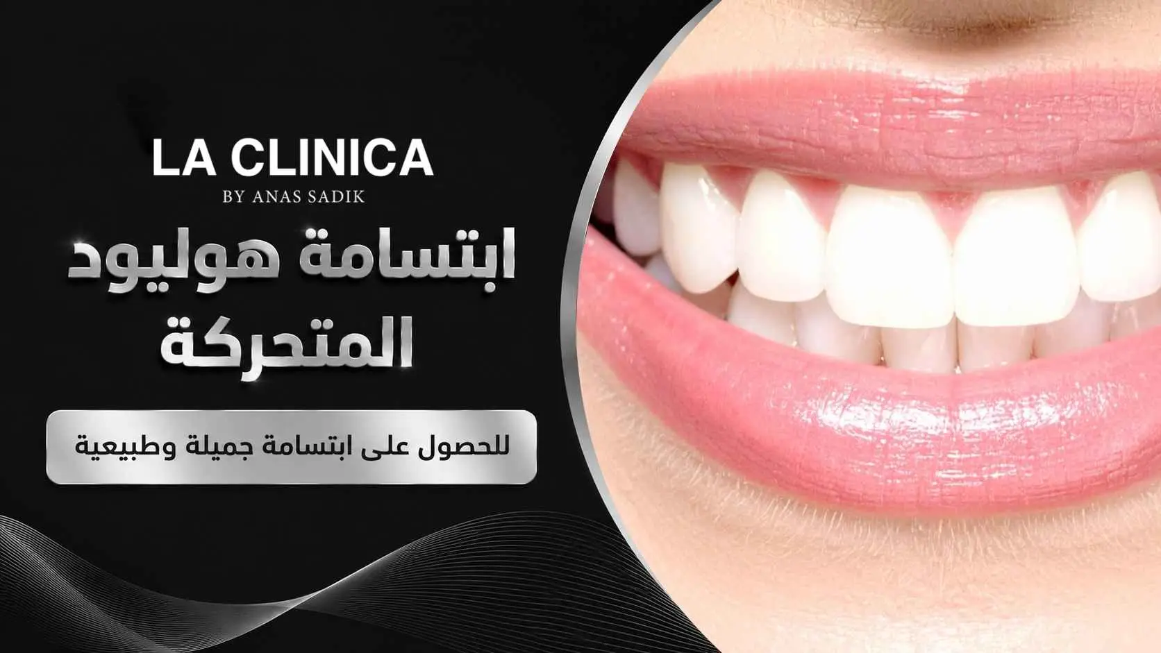 ابتسامة هوليود المتحركة للحصول على ابتسامة جميلة وطبيعية