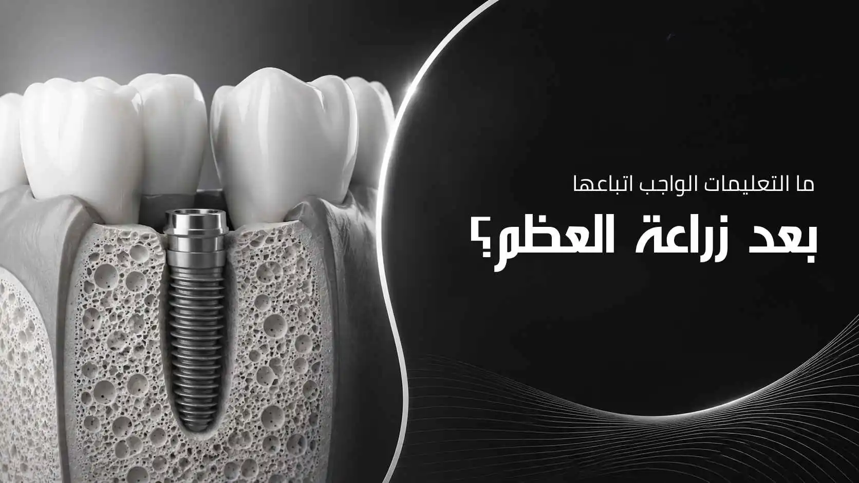 زراعة العظم للاسنان