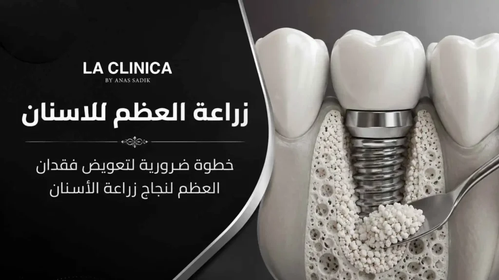 زراعة العظم للاسنان